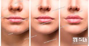 after lips filler injections