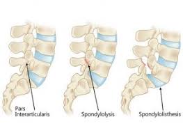 In this article we will discuss about backbone.js collections. Diagnosis And Treatment Of Pars Defect Orthocenter Illinois