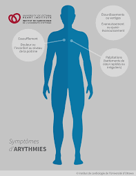 Arythmies (anomalies du rythme cardiaque) – Institut de cardiologie de  l'Université d'Ottawa