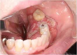 lower gingival squamous cell carcinoma