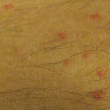 flea bites on humans symptoms and