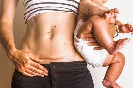 Cesarean section scar ectopic pregnancies are a rare complication of pregnancy that may follow previous hysterotomy for any cause, uterine manipulation, and in vitro fertilization. You Vs Your C Section Pooch How To Love And Heal Your New Body She Births Bravely