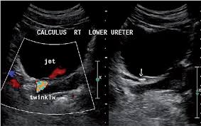 Value Of Color Doppler Ultrasound Kub And Urinalysis In