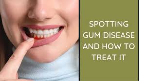 spotting gum disease and how to treat