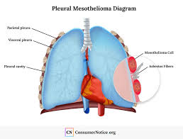Most cases of lung cancer are associated with. Asbestos And Mesothelioma Symptoms Stages Treatments