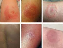 lyme disease and the em rash