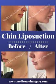 Check spelling or type a new query. How Much Is Chin Lipo Uk Guide At En Lp Diamonds Net