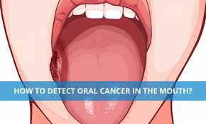 how to detect cancer in the mouth