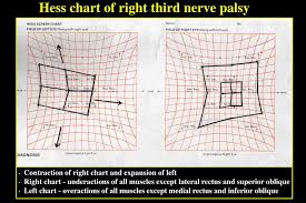 Ppt Ocular Motor Nerve Palsies Powerpoint Presentation