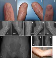 nail patella syndrome causes symptoms