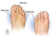 Image result for icd 10 code for callus on feet