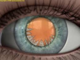 Cataract Pingree Eye Center