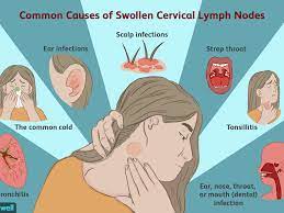 Then a couple of days later he called me and said my throat swab came back positive for pseudomonas. Enlarged Cervical Lymph Nodes