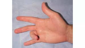 do you have trigger finger syndrome