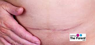 Learn about the healing process, minimizing the scar, and what to expect. C Section Scar Care For Quick Healing And Recovery Being The Parent