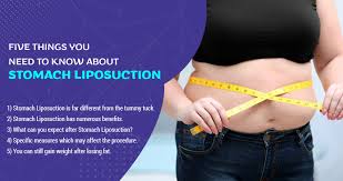stomach liposuction need to know