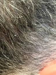 seborrheic dermais on the scalp