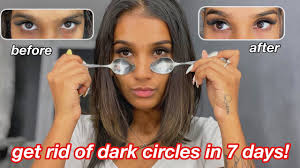 how i got rid of my dark circles in 7