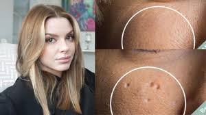 how to get rid of indented acne scars