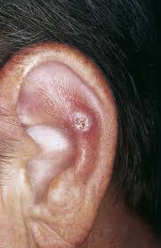 cutaneous lesions of the external ear
