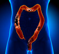 Changes in your bowel habits, such as diarrhea, constipation, or narrow stools that last more than a few days. Just Do It Yourself At Home Colorectal Cancer Screening Harvard Health Blog Harvard Health Publishing