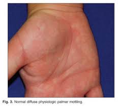 Palmar radioulnar ligament, a narrow band of fibers in the wrist joining the ends of the arm bones; Gale Academic Onefile Document Palmar Erythema