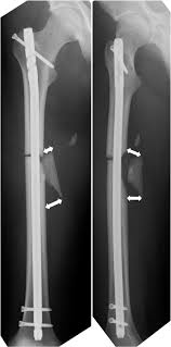 fem shaft fractures