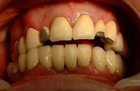 before after tibor dental