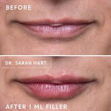 before and after photos by dr sarah hart