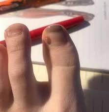 spotting a melanoma on the fingernail