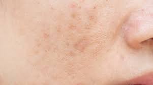 dark spots on face common causes and