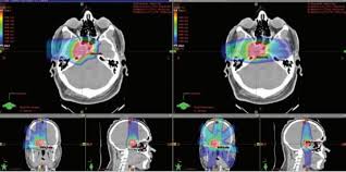 proton therapy for skull base tumors