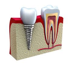 Image result for dental implants