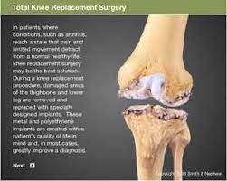 knee total replacement