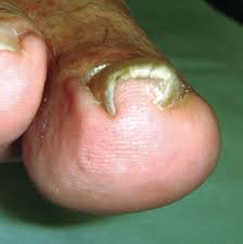 pincer nail deformity clinical