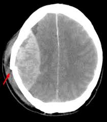 The images show a subdural hematoma. Extradural Haematoma Edh Geeky Medics