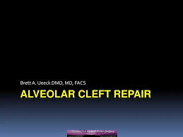 ppt alveolar cleft repair powerpoint