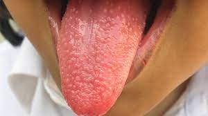 Girl develops 'strawberry tongue' during bout with strep throat | Fox News