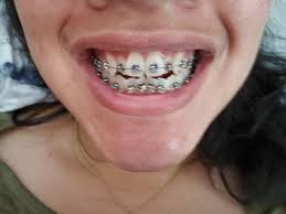 Having concerns about your child's teeth? Adult Braces Reddit 5 Honest Invisalign Before After Reviews All New Teeth