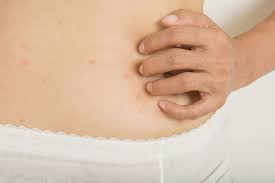 hives on stomach rash causes triggers