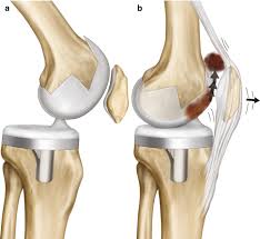 Total Knee Arthroplasty Springerlink
