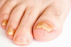 is toenail fungus painful