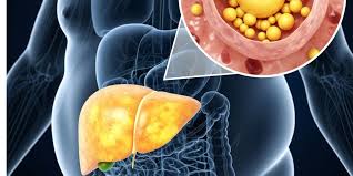 आपका लिवर हो रहा फैटी? शरीर में दिखते हैं ये 8 संकेत, न करें इग्नोर - Fatty liver disease early 8 warning signs mostly people ignore tvisx