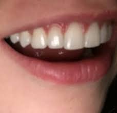 When you take your braces off, you'll be left with a beautiful straight smile. Your Opinion On My Teeth After Braces Is There Anything I Can Do I Think That My Front Teeth Stick Out After Braces Photo