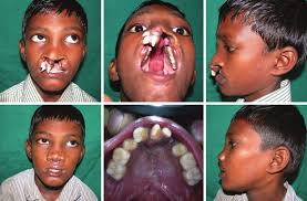 bilateral cleft of the lip and palate
