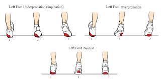 Foot Pronation And Supination Chart Park Sports Physical