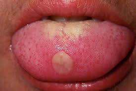 mouth sores picture guide 16 images of