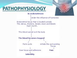 It may attach to the ovaries, fallopian tubes, the exterior of the uterus, the. Endometriosis Easy Explanation With Management