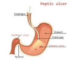 Peptic Ulcer Dr Bansal Associates