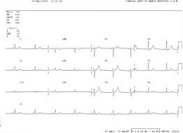 How To Read An Electrocardiogram Ecg Part One Basic